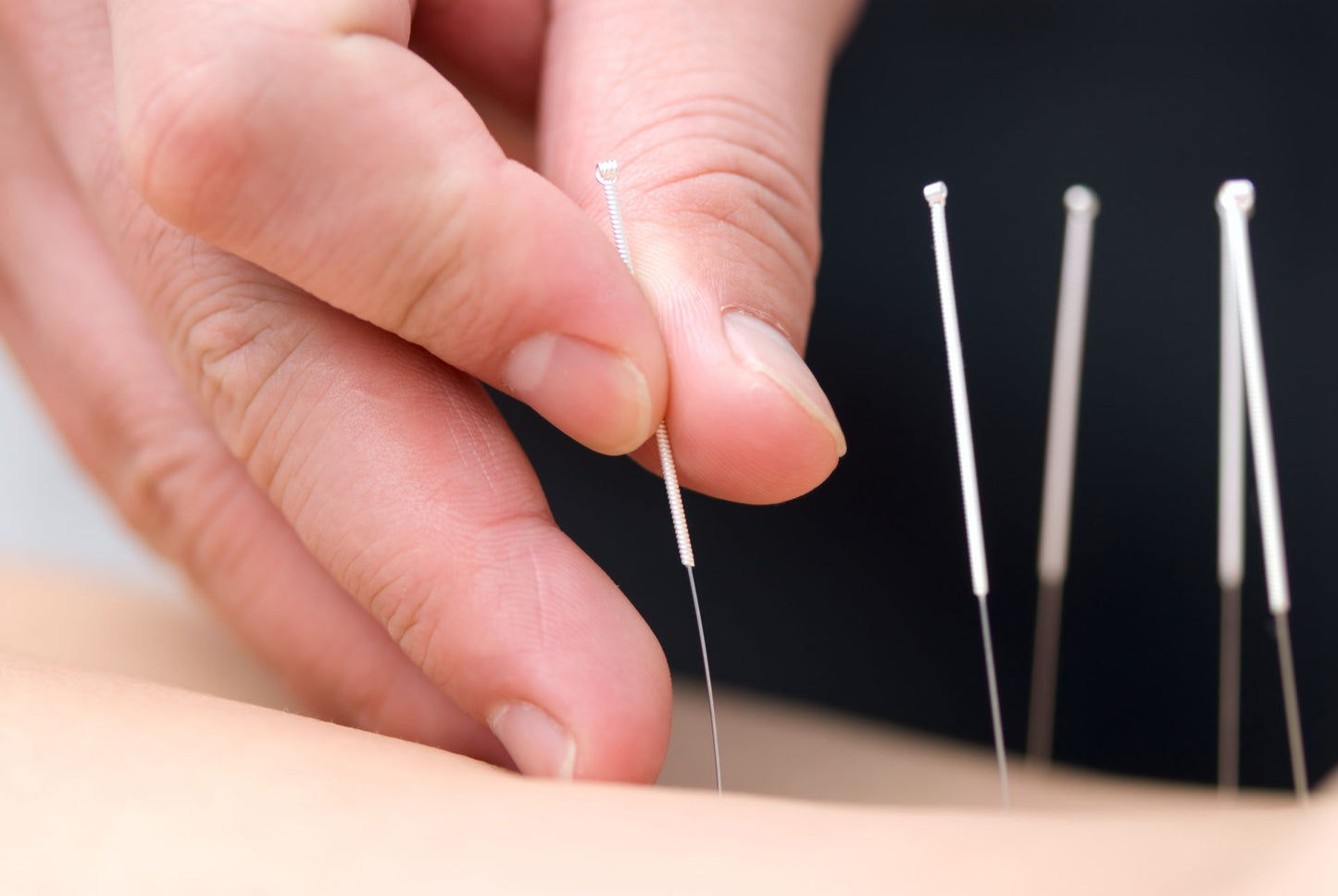 AcuPro naald - 0,25 x 50 mm - Dry Needling - Acupunctuur